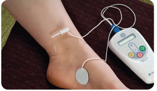 percutaneous-tibial-nerve-stimulation-ptns